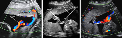 Velamentous Cord Insertion Ultrasound Velamentous Cord Insertion Ultrasound