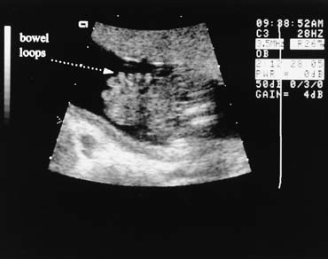 ultrasound gastroschisis
