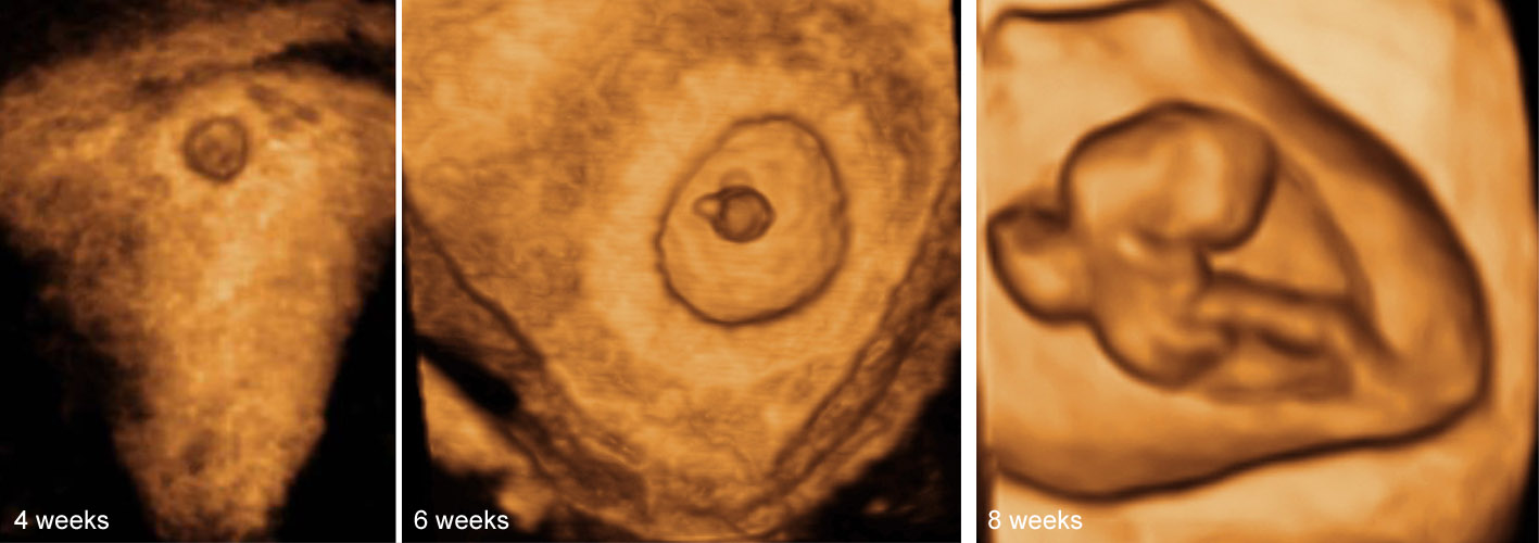 The gestational sac in 3D ultrasound at 4–7 weeks' gestation.