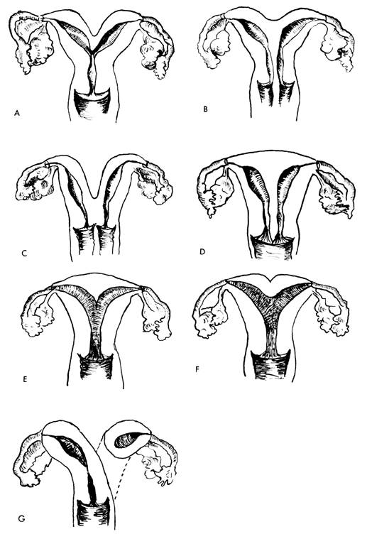 B Uterus duplex with double vagina C Uterus didelphys