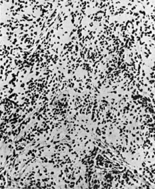 la neurofibromatosis y el amor