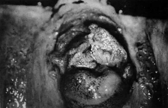 Vaginal and cervical adenosis Vaginal and cervical adenosis