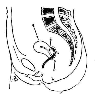 tilted cervix pregnancy