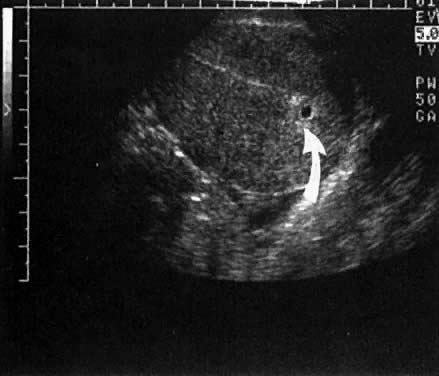 A very early, 3-mm mean diameter intrauterine gestational sac at 5 weeks 