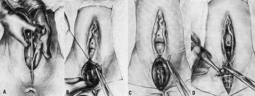 Median episiotomy. A. Perineal incision exposes sphincter ani.
