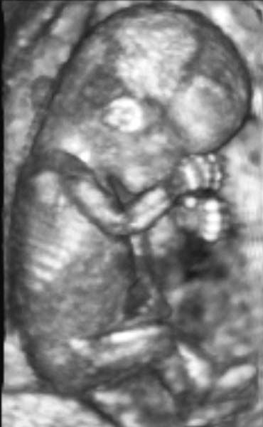 3d ultrasound pictures of twins. 3D image of a fetus in the