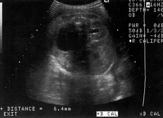 Horseshoe Kidney Ultrasound. The left kidney is enlarged