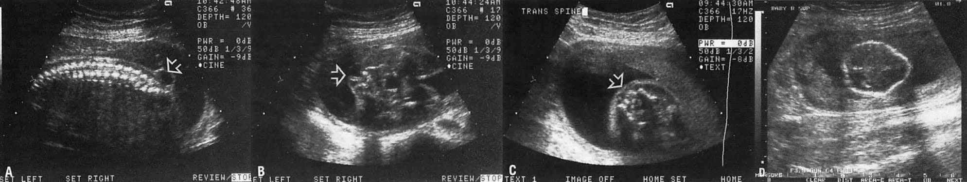 Duodenal Scalloping