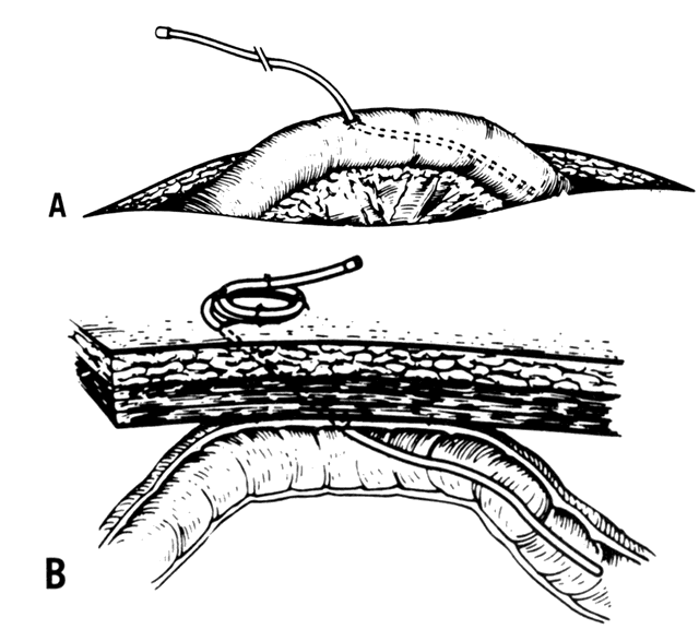 A. At laparotomy, a catheter is placed approximately 40–50 cm antegrade 