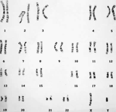karyotype male. Normal male karyotype 46,XY