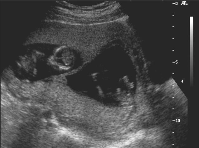3d ultrasound pictures of twins. twins, and the placenta