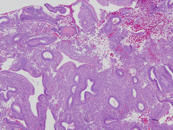 What is the treatment for disordered proliferative endometrium?