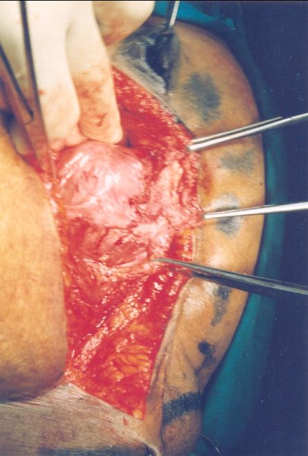 Classic adhesions following cesarean section seen at laparotomy.