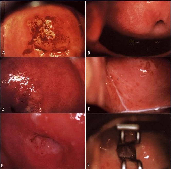 lip of the cervix exhibits