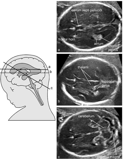 Fetal Brain Ultrasound Labeled