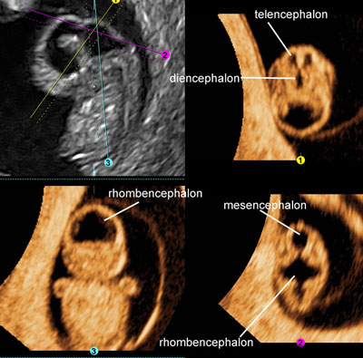 Ultrasound pregnant 8 weeks Ultrasound At
