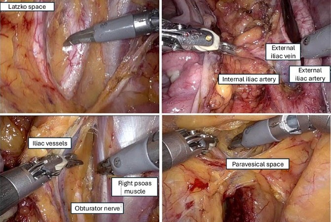 Advancing gynecological oncology through endoscopy
