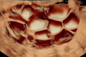 Ultrasound's role in benign ovarian mass diagnosis