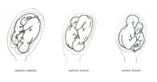 cephalic presentation for twins