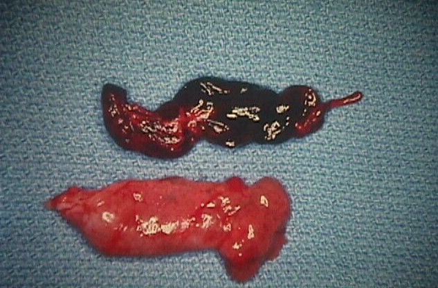 Tubal ectopic pregnancy