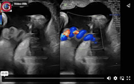 The clinical imperative of placental and cord imaging