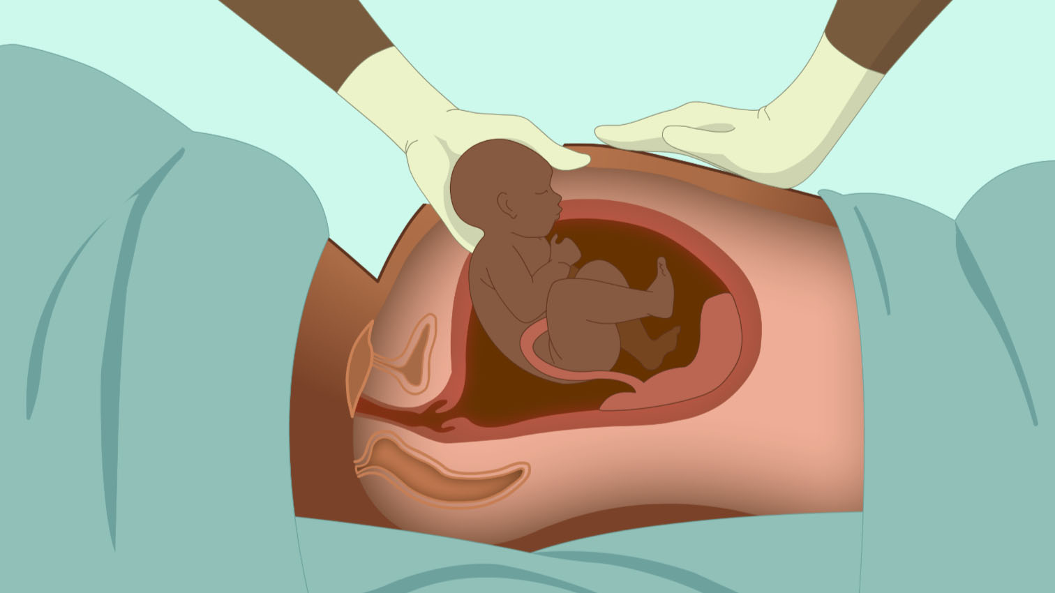 wow-l2-cesarean-section-id10061-01.jpg