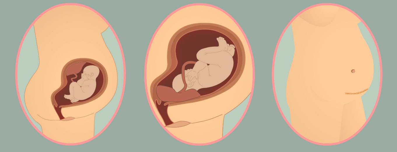 wow-l2-cesarean-section-id10061-02a.jpg