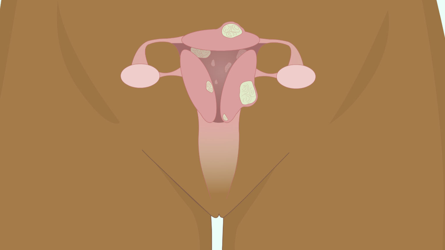 wow-l2-painful-periods-and-heavy-menstrual-bleeding-id10068-04.jpg