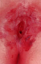 Labial adhesion (labial agglutination) — All Things Vagina