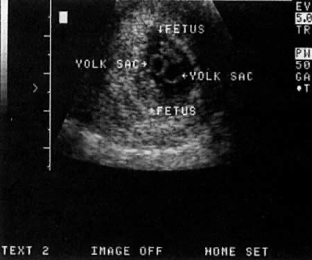 Can a dating ultrasound be 2 weeks off