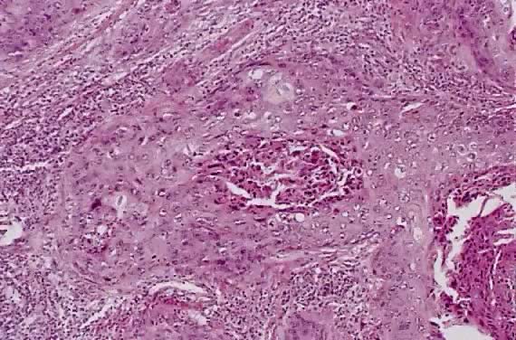 Large cell carcinoma lung histopathology report