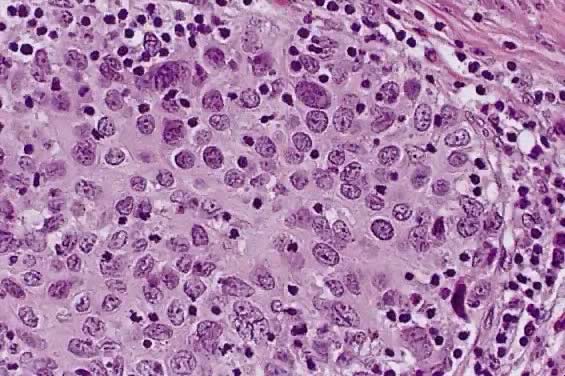 Large cell carcinoma lung histopathology report
