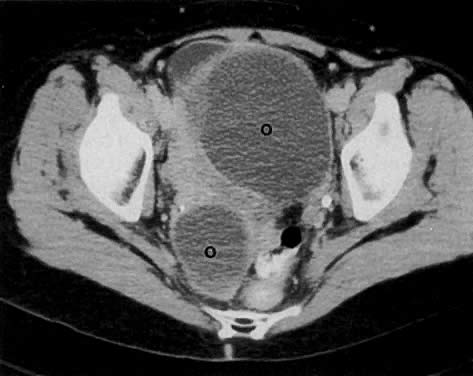 ovarian cancer on ct scan